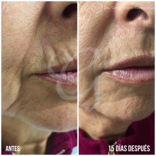 image of Image avant et après l'acide hyaluronique Clínica Moratalaz 66
