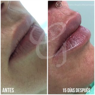 Image avant et après Acide hyaluronique Clínica Moratalaz 66