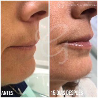 image of Image before and after Hyaluronic Acid Clínica Moratalaz 66