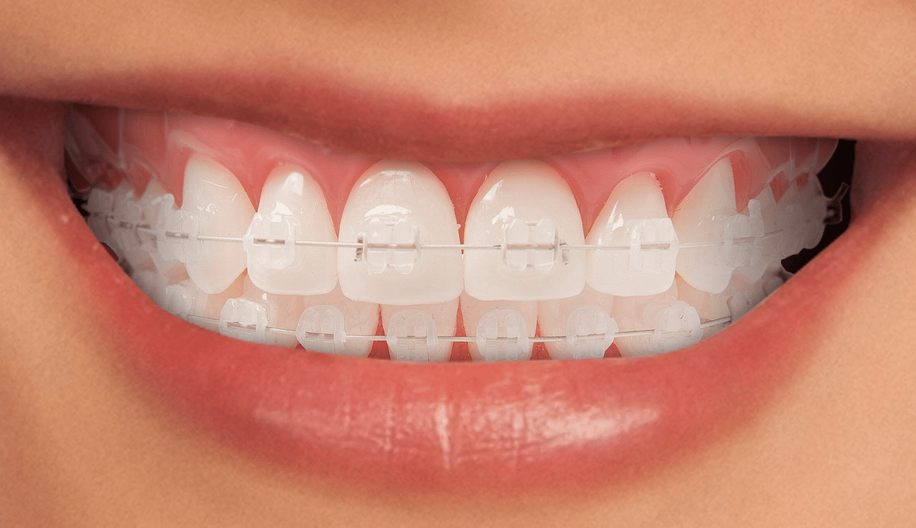 image of orthodontic aesthetic braces dental clinic moratalaz
